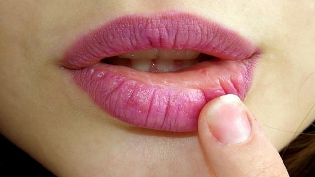 acido hialuronico labios